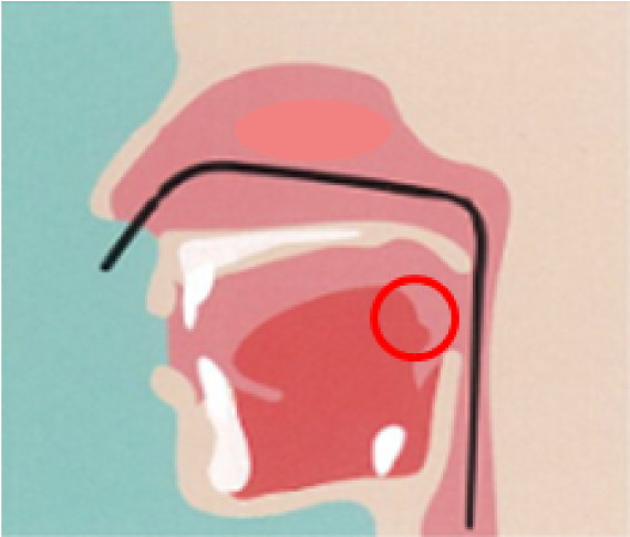 経鼻的挿入